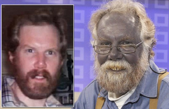 argyria paul karason